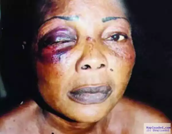 Photo: Housewife Loses Eye After Fight With 79-Year-Old Mother-In-Law
